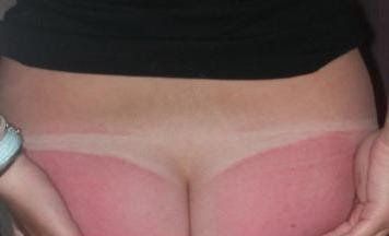 Sunburn ass