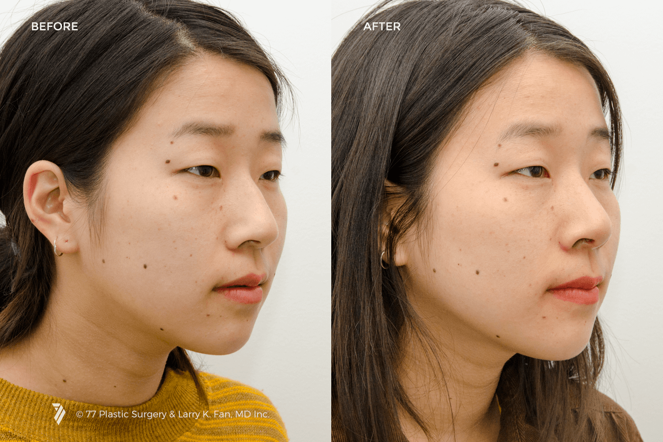 Asian nose job before and after