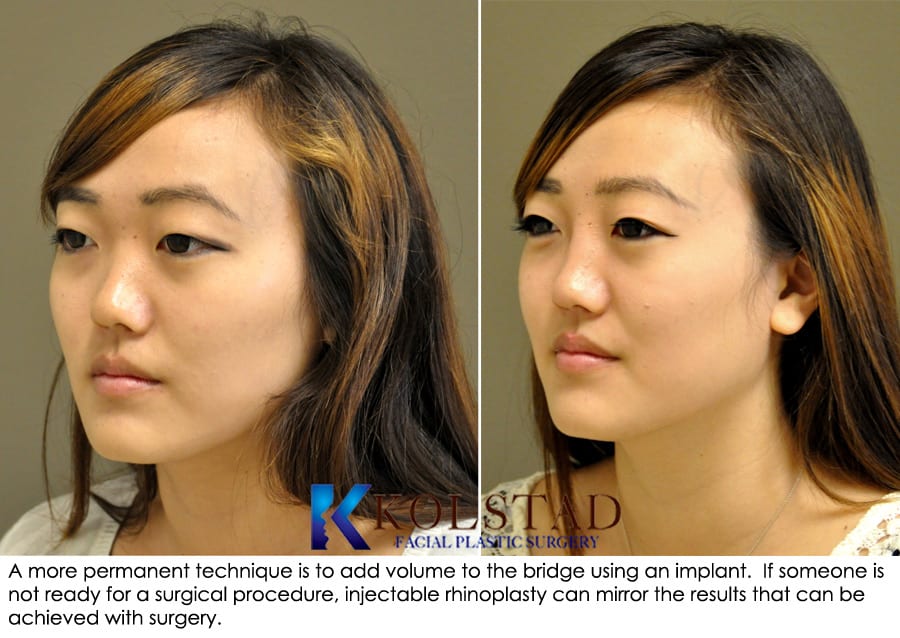 Asian nose job before and after