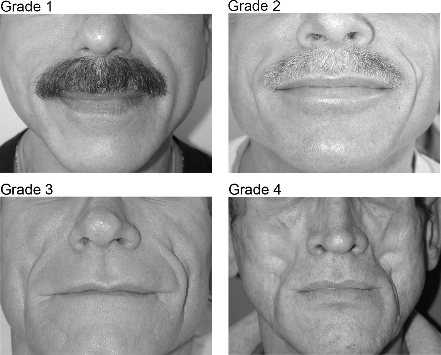 Hiv facial lipoatrophy image