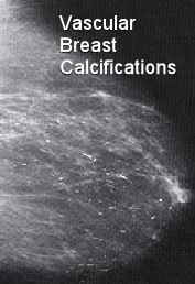 best of Breast Benign calcification