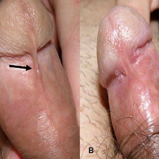 Gosling recommendet lesion penis Skin on