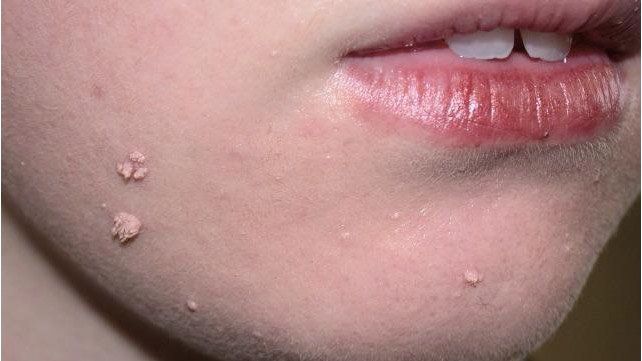 Tackle reccomend Cause of facial warts