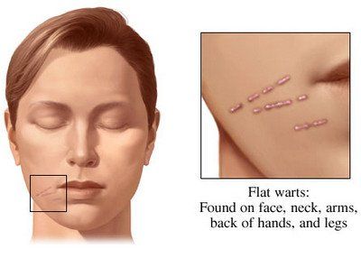 Moses reccomend Cause of facial warts