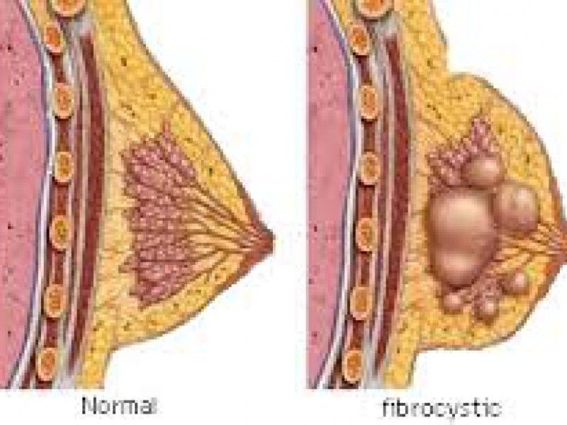 Code M. reccomend Causes of fibrocystic breast
