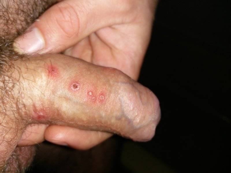 Officer reccomend Skin lesion on penis