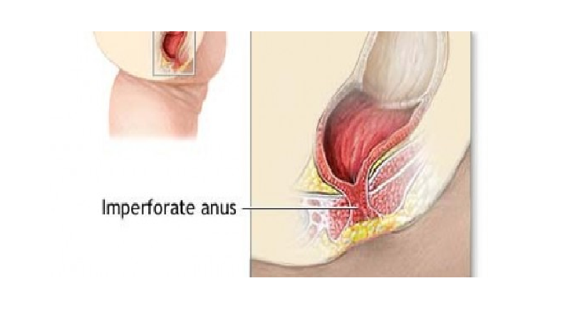 best of Imperforate anus Pediatric