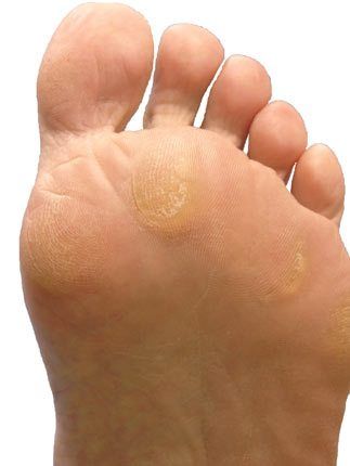 best of The of foot Callus bottom on