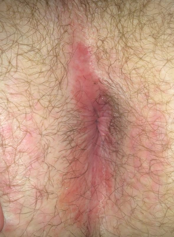 best of Anus Inflamed burning