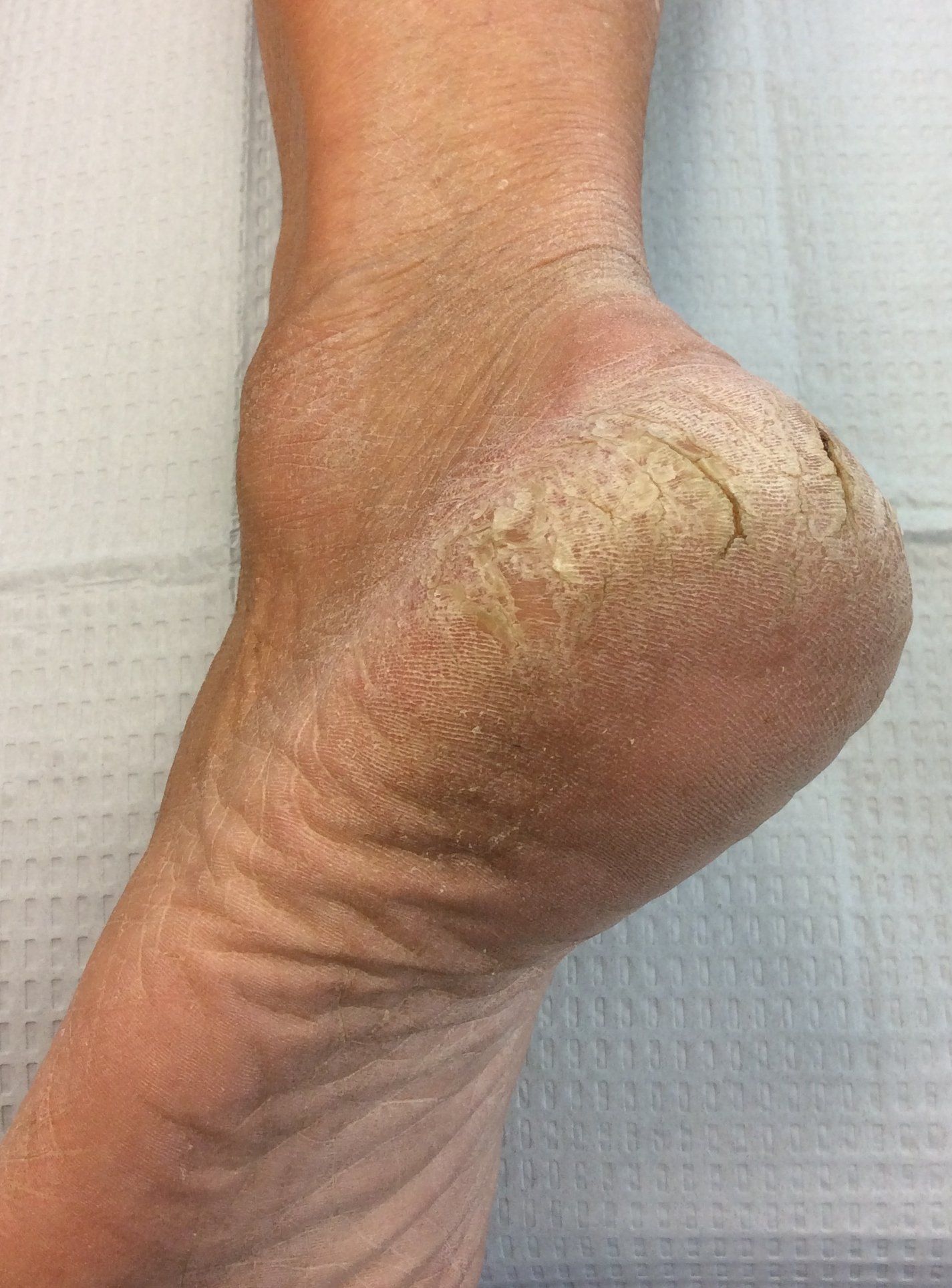 Callus on the bottom of foot