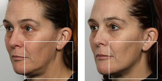 best of And Microcurrent after before facial