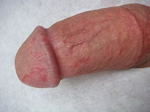 best of Penis on Skin lesion