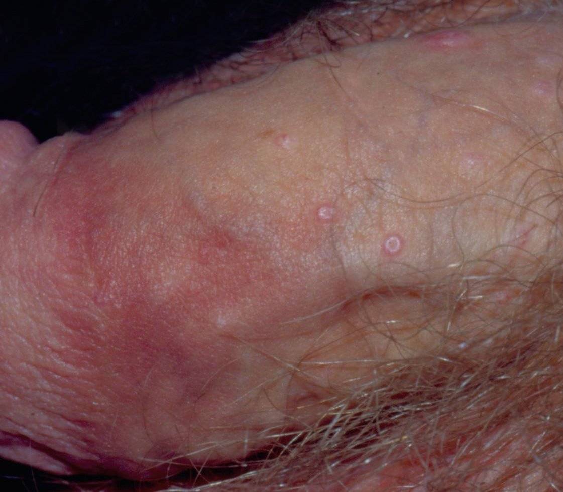 best of Penis on Skin lesion